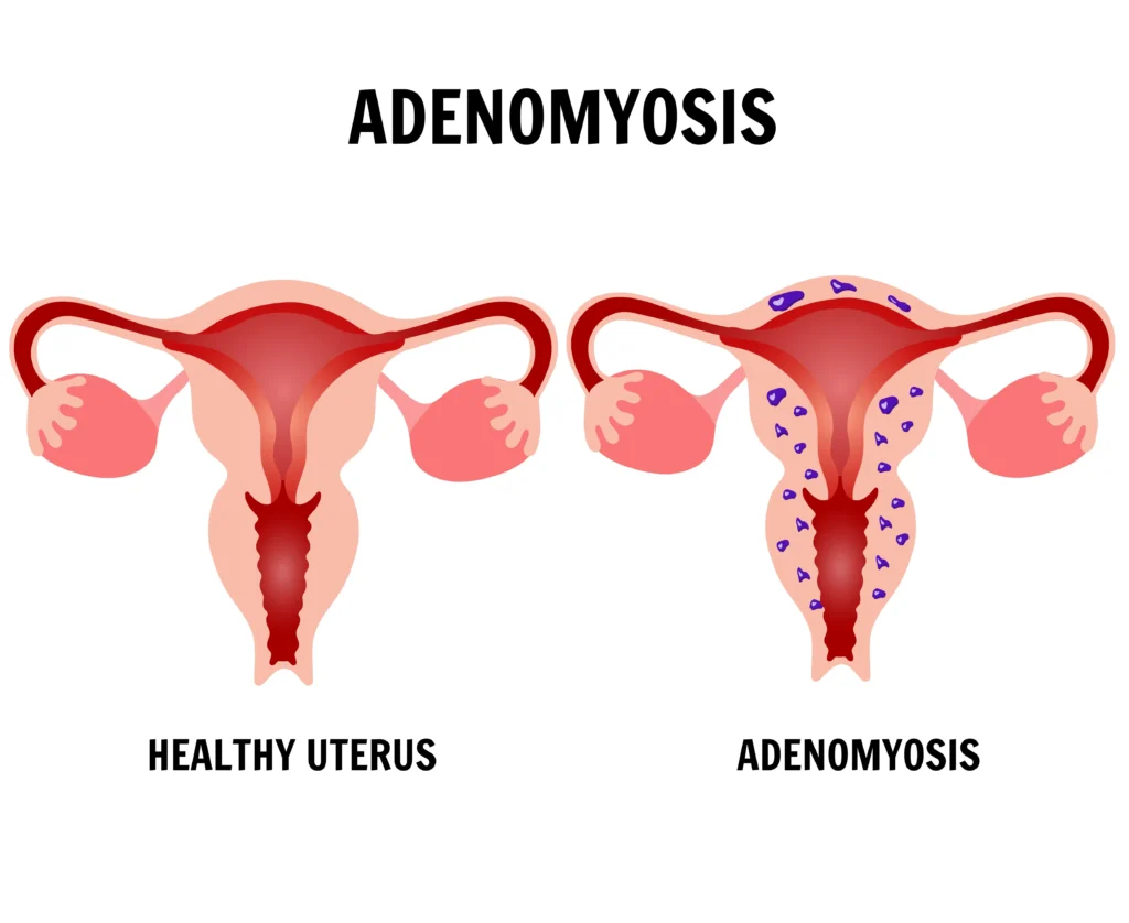 Adenomyosis Treatment in Indore, gynecologist in indore, female gynecologist in indore,