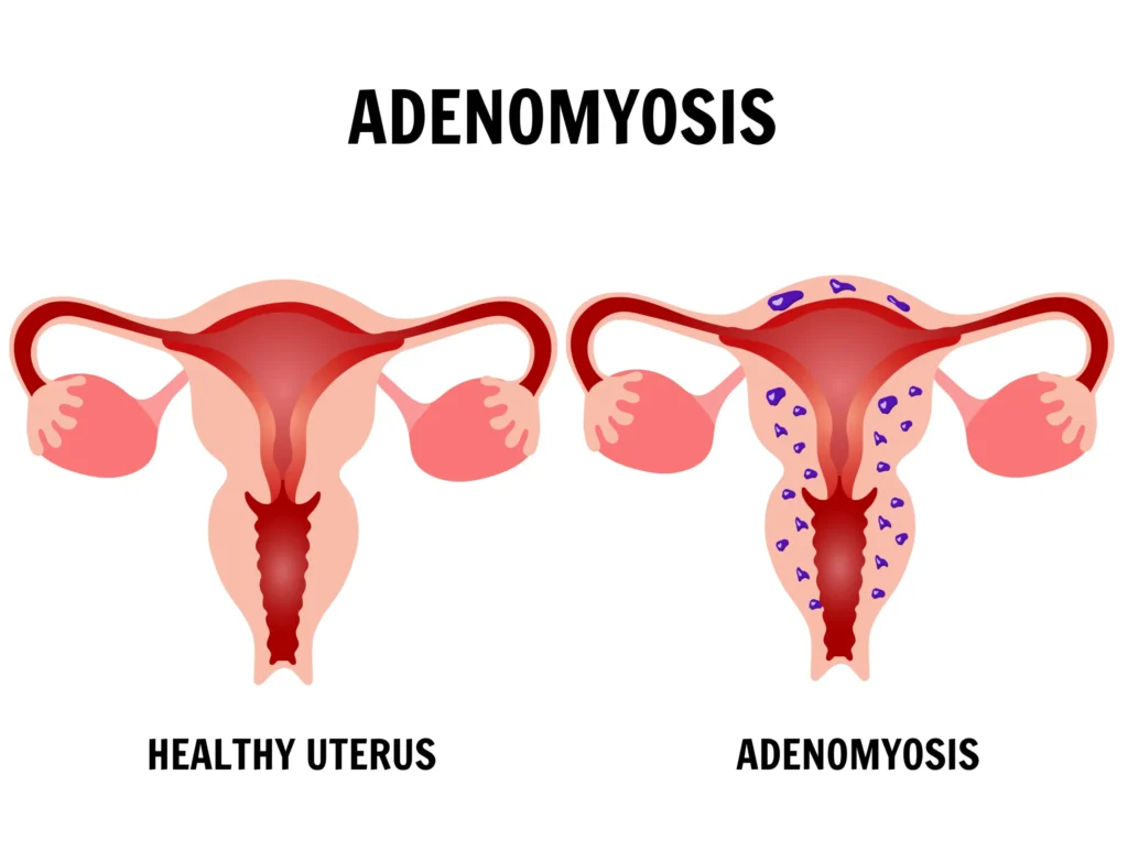 Adenomyosis Treatment in Indore, gynecologist in indore, female gynecologist in indore,