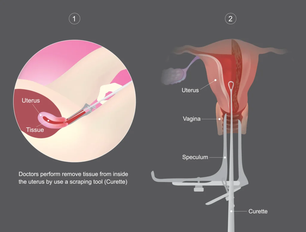 Dilatation and Curettage in Indore