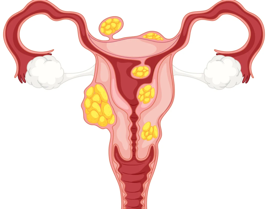 fibroid treatment in indore, gynecologist in indore, female gynecologist in indore