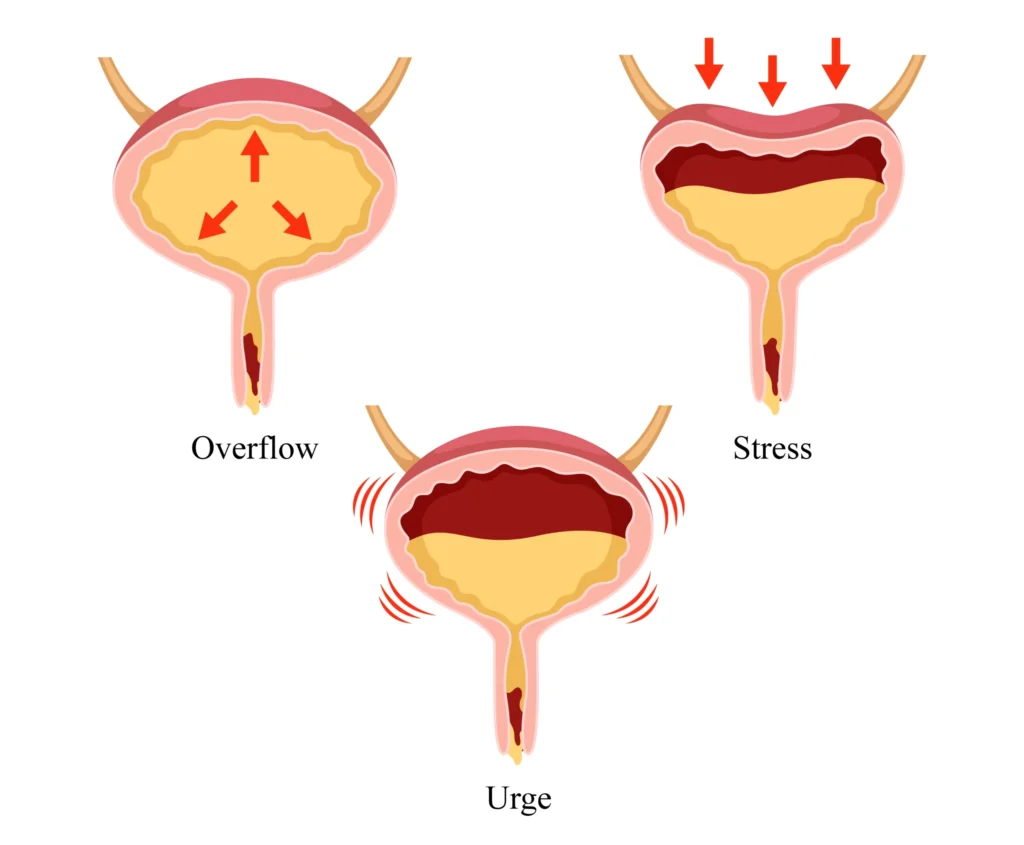 Laser Treatment in Indore for Urinary Incontinence