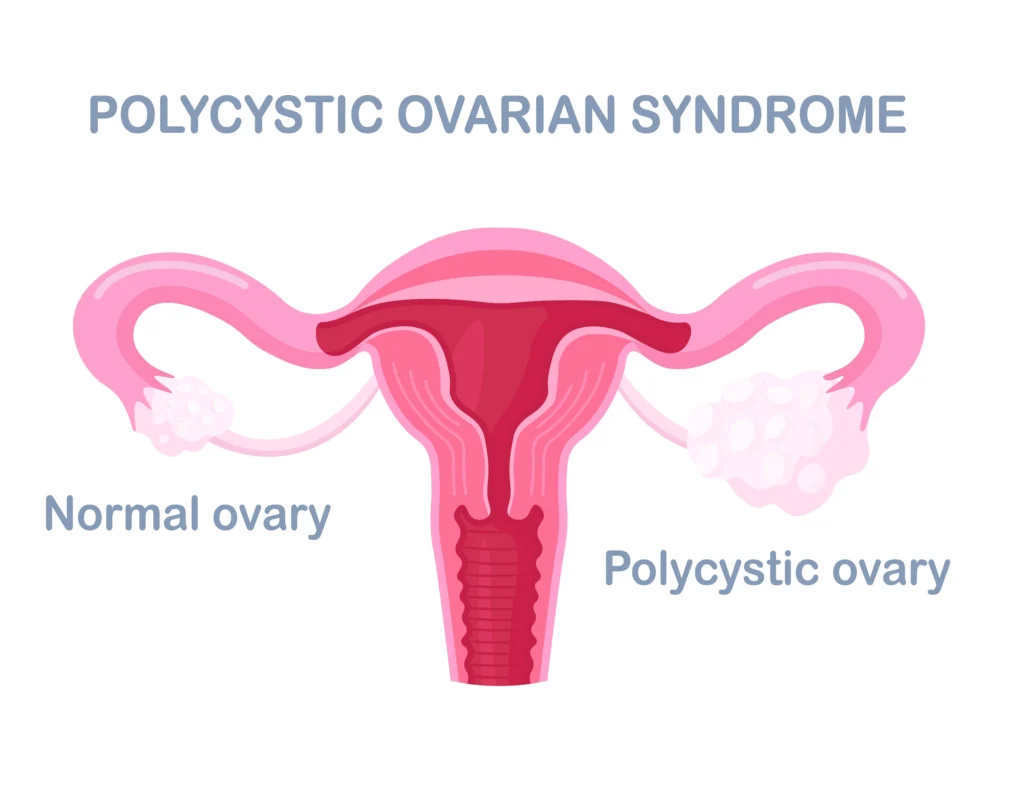 pcos treatment in indore, gynecologist in indore, female gynecologist in indore